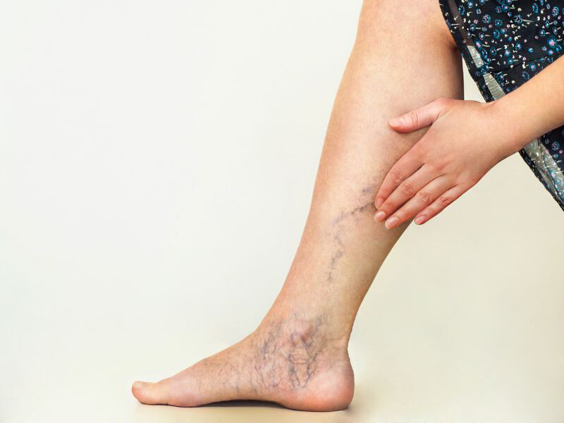 Hình ảnh bệnh lý giãn tĩnh mạch chân