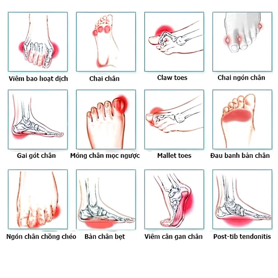 Đau Lòng Bàn Chân Là Bị Gì
