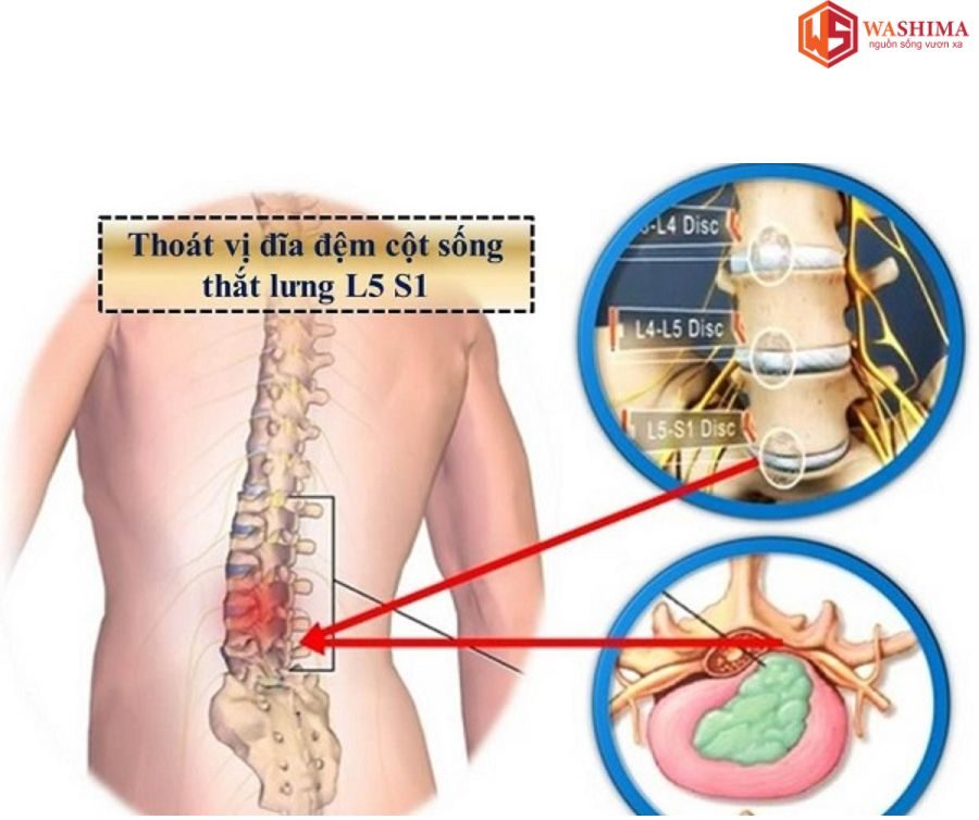 Nguyên nhân gây thoát vị đĩa đệm thắt lưng