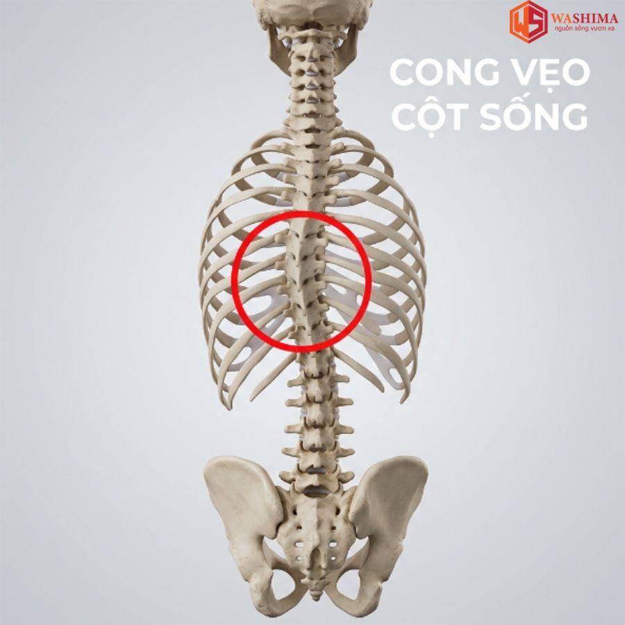 Thoát vị đĩa đệm thắt lưng có chữa được không?