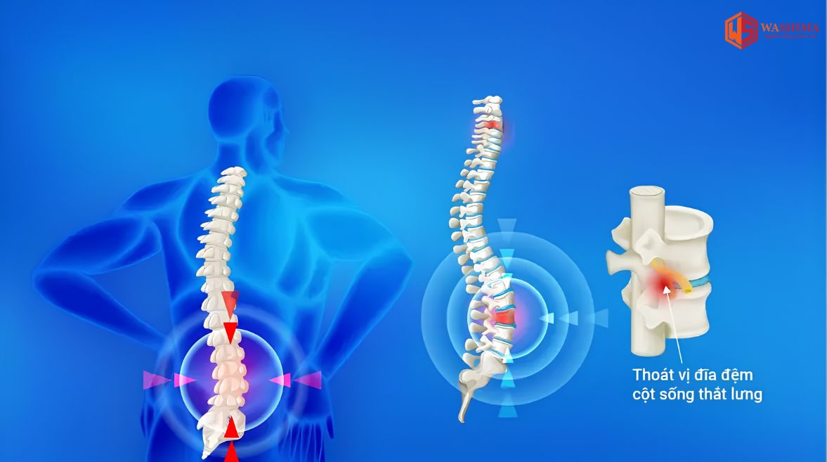 Đau cổ vai gáy kéo dài