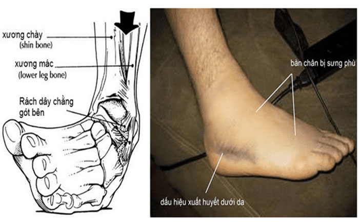 Cách giảm đau mu bàn chân tại nhà