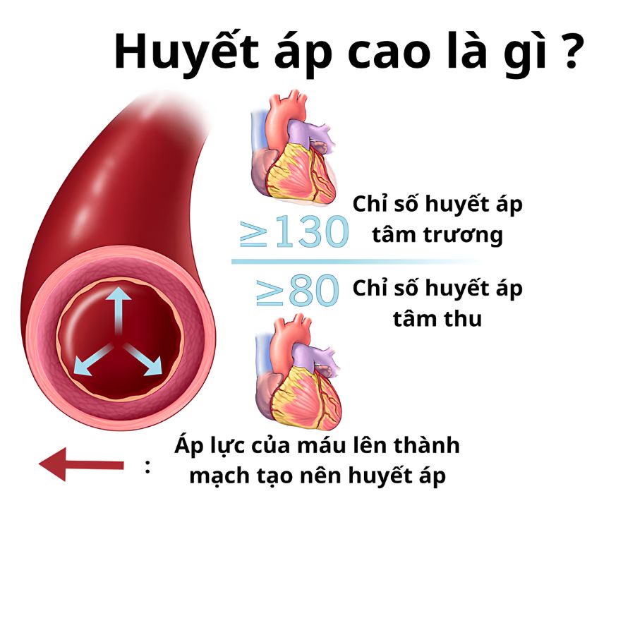 Nguyên nhân huyết áp cao